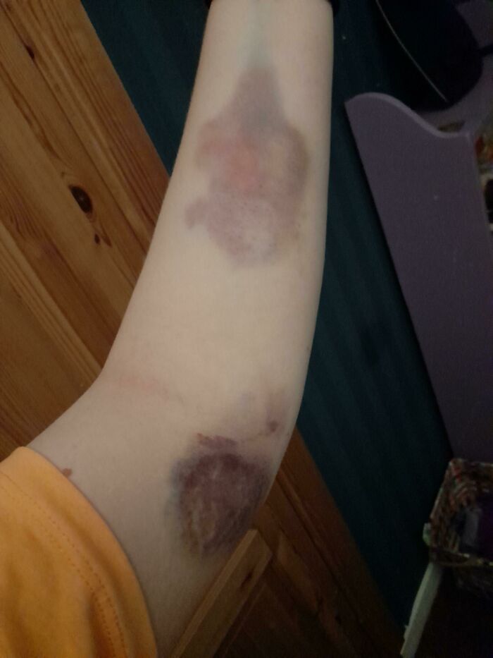 My Gnarly Bruise From Archery With No Arm Guard
