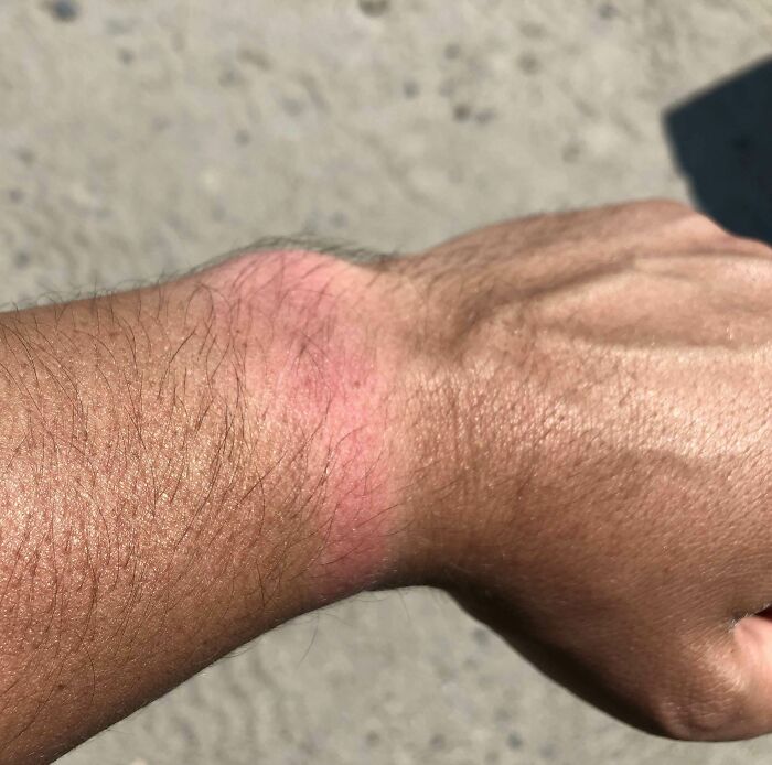 I Didn’t Wear My Watch To The Beach And Got A Strip Of Sunburn