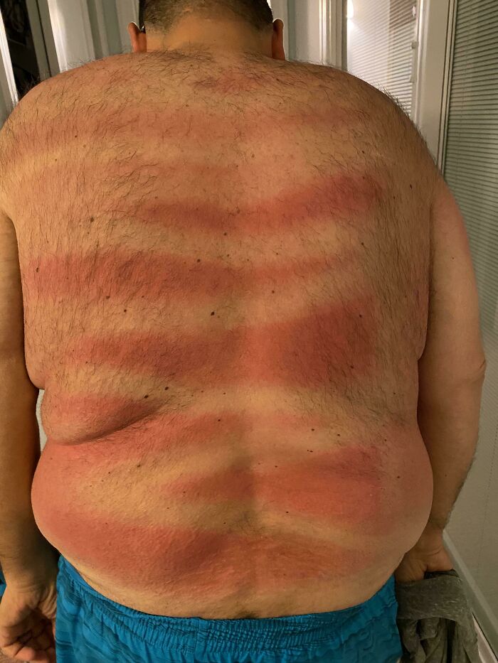 Primer día en la playa y mi esposa se aseguró de que me protegiera de las quemaduras solares rociando mi espalda con protector solar. No puedo ver ahí atrás, ¿hizo un buen trabajo?