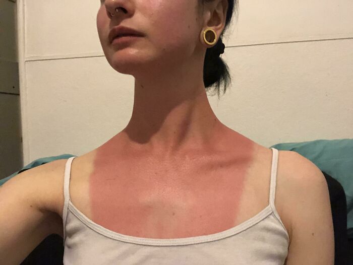 Went Out On A Boat Without Sunscreen Today And Now I Have What I Am Calling “The Bib Of Pain”