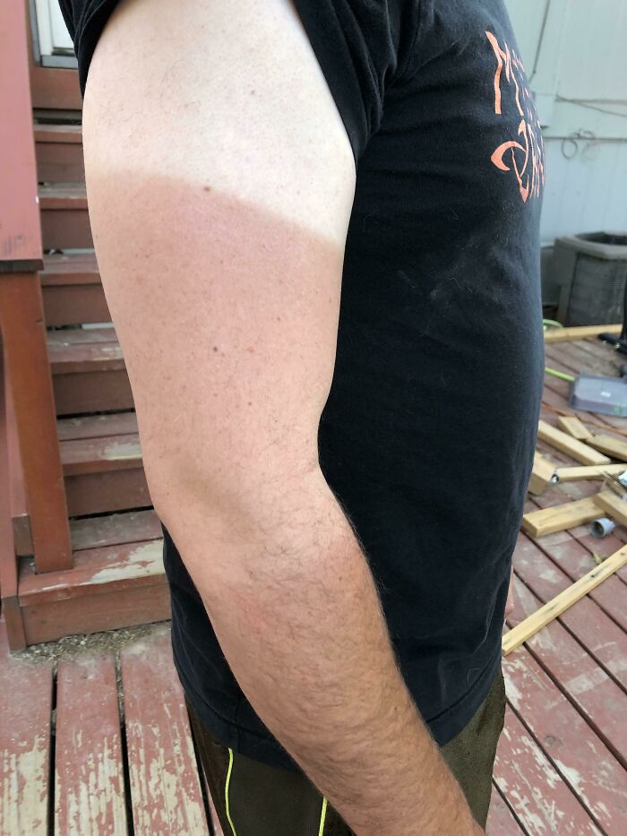 My Fiance Has Three Shades Of Skin On His Arm Right Now