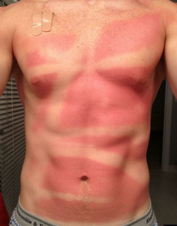Be Careful When Applying Spray-On Sunscreen