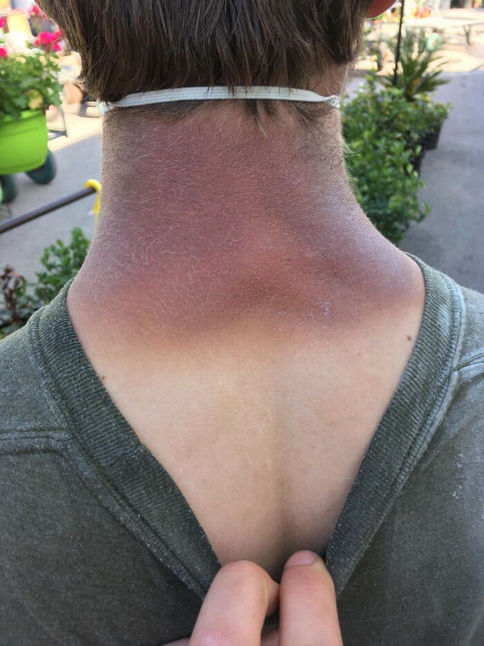 This Sunburn I Got While Working On Top Of A Greenhouse All Day