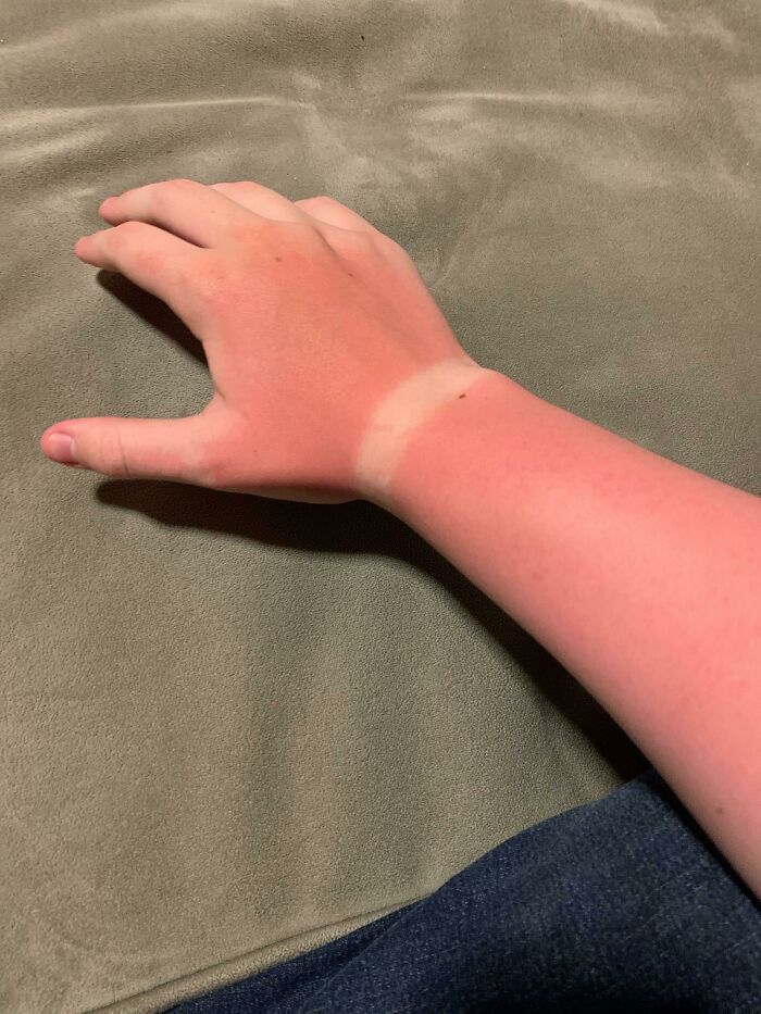 Went To A Water Park With A Bracelet On And No Sunscreen. Pain