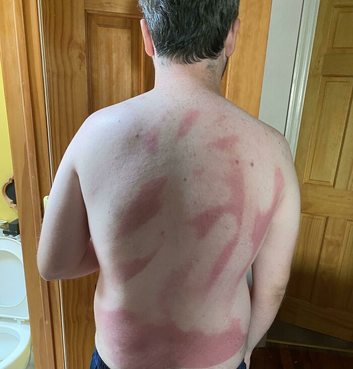 Tried To Put Sunscreen On My Back