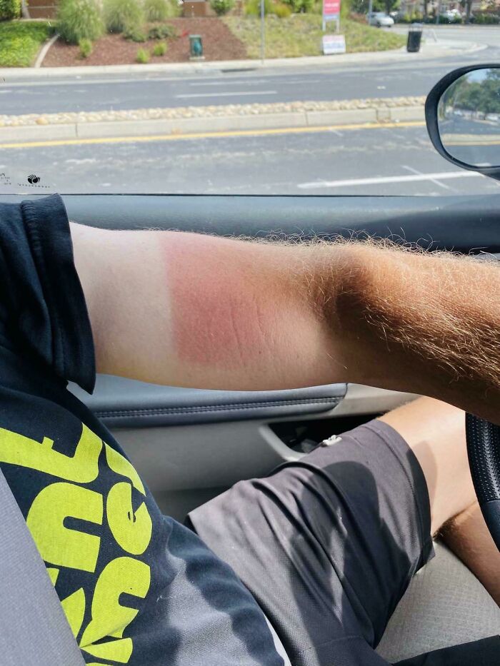 My Dad Wore A Shirt That Didn’t Fully Coverup His Untanned Sections And Got Really Burnt. His Arm Looks Like A Neapolitan Ice Cream