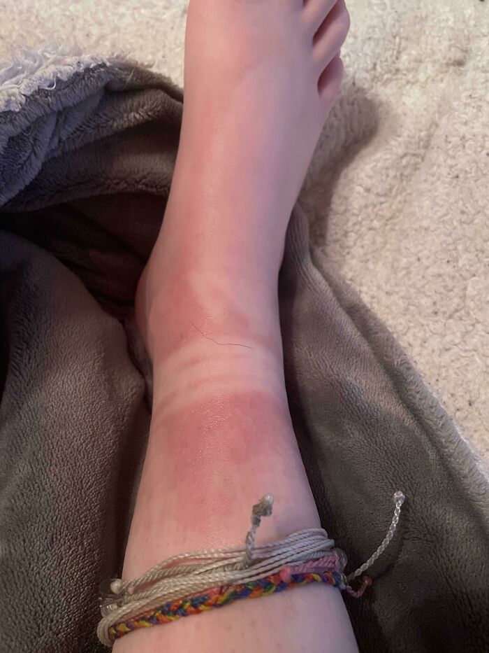 Got This Nice Little Sunburn Almost 2 Weeks Ago, Really Dark Red Almost Purple So I Think It’s Gonna Be Around For A While