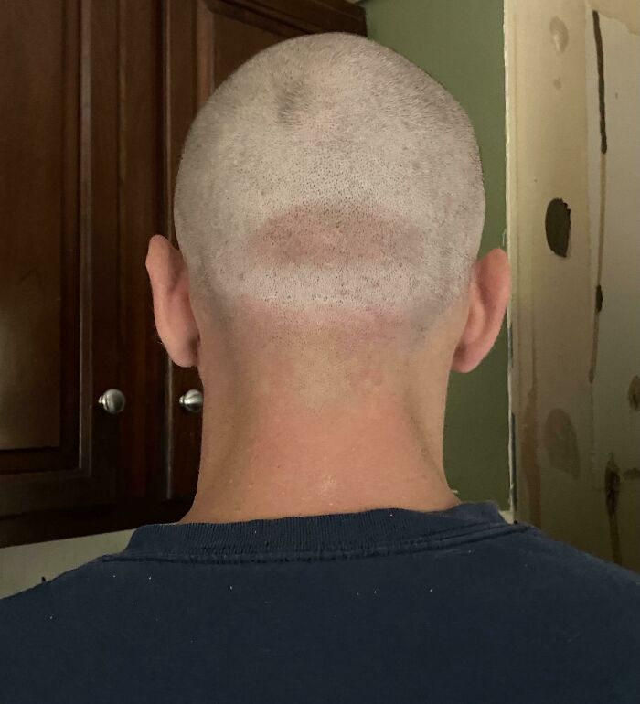 My Husband Started A New Job Outside, He Wore His Hat For The First Week, Resulting In His New Tan Line