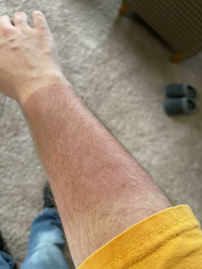 Forgot To Put Sunscreen On Before I Hopped On The Motorcycle, And As A Result I Have This Sweet New Tan Line