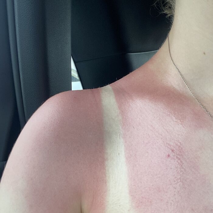The Result Of 15 Minutes In The Australian Sun Without Sunscreen. Currently On Day 3 Post Burn And While Some Of It Is Improving, Other Parts Look Purple And Are Blistering