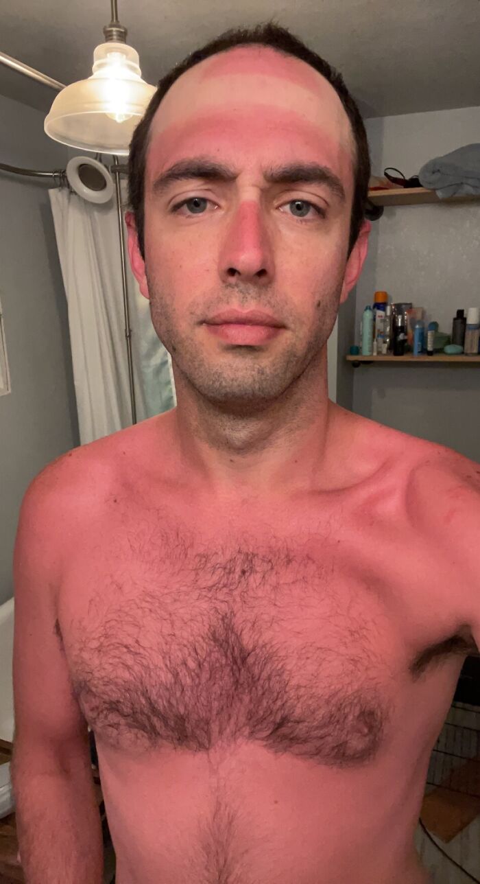 Like An Idiot, I Chose To Not Wear Sunscreen
