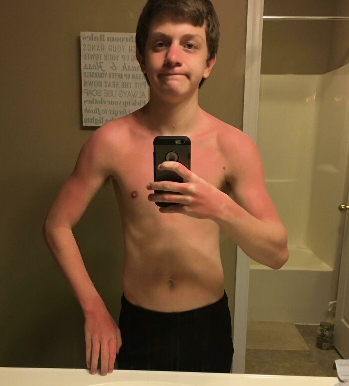 This Is Why We Reapply Sunscreen (I Was Pretty Much Stuck In Bed For About 3 Days)