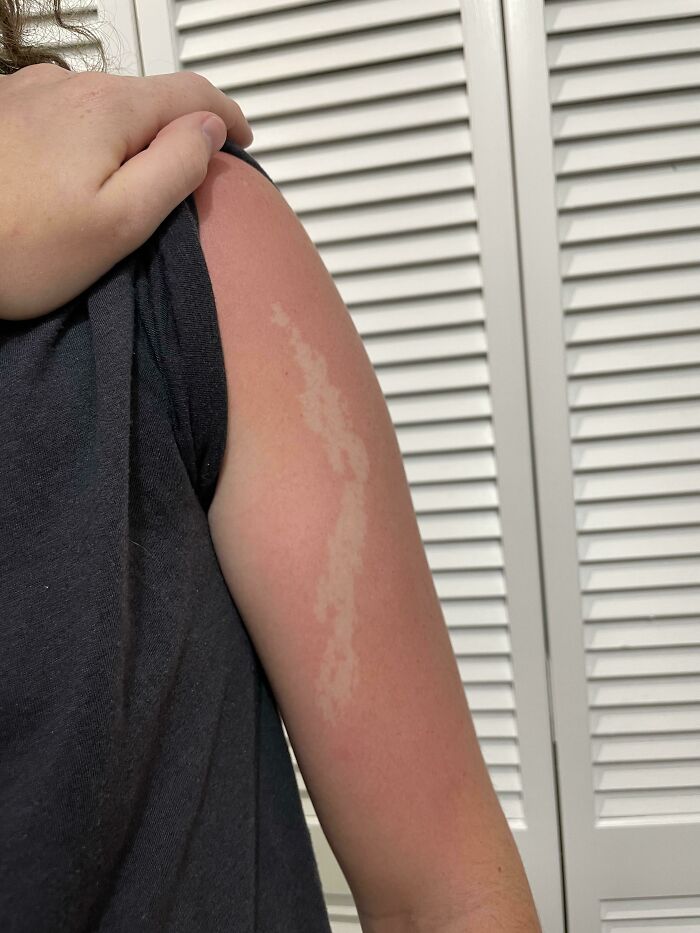 This Patch On My Skin Never Tans/Burns. I’ve Had It Since I Was Born