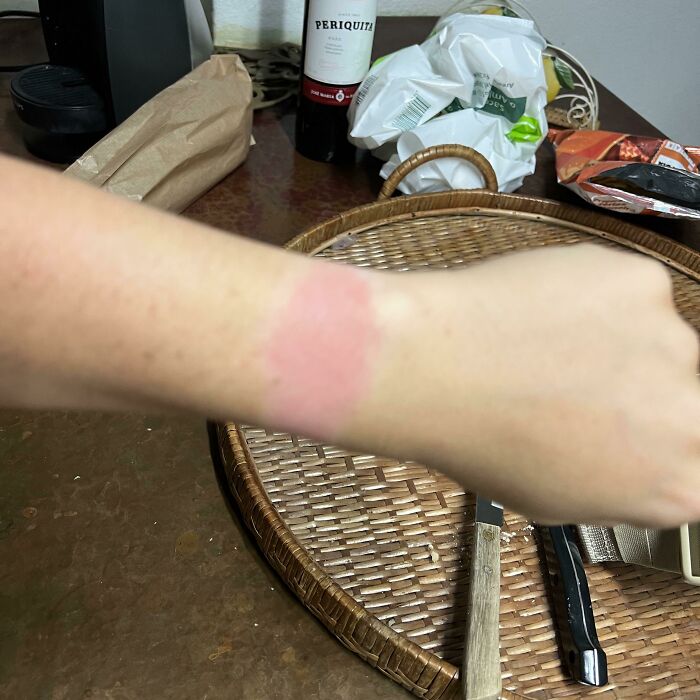 Sunburn On Wristwatch Tan Line