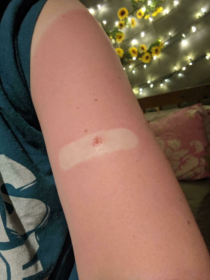 Got A Sunburn After Putting A Band-Aid On