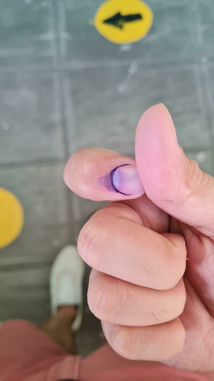 Indelible Ink Is Dropped On Your Fingernail After Voting To Prevent People From Voting Twice In The Philippine Elections