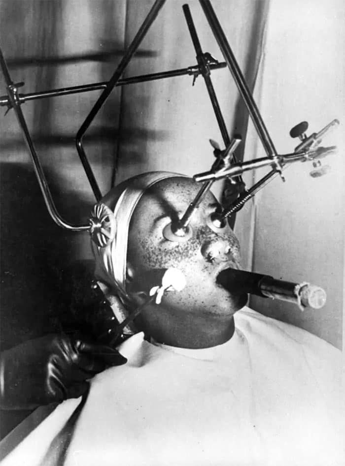 #8 Freckle Removal. A Complicated Apparatus Is Employed. Eyes Are Covered With A Special, Air-Tight Piece, And The Nostrils Filled In. Breathing Is Done Through A Special Tube. Sensitive Parts Of The Face Must Be Treated Separately, 1930