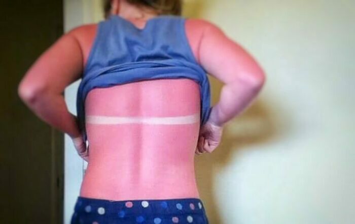 Throwback To 2011 On Exactly Why I Should Not Be Allowed In The Sun. Even With Sunscreen I Can't Escape The Burn