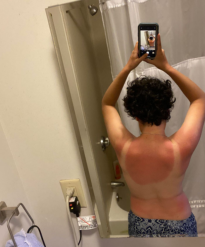 Massive Sunburn After A Day At The Beach