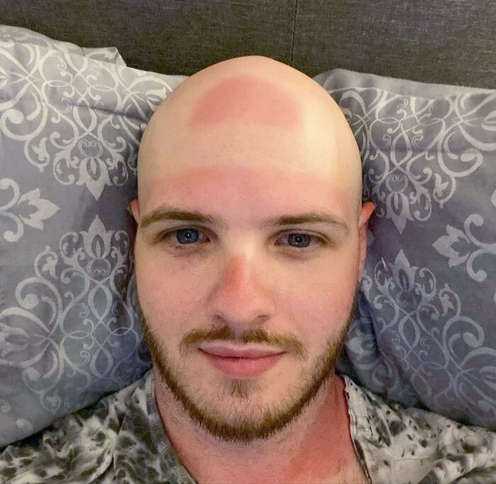 Throwback To That Time My Backwards Hat And Lack Of Sun Cream Resulted In A Hat Imprint Being Burnt Onto My Forehead