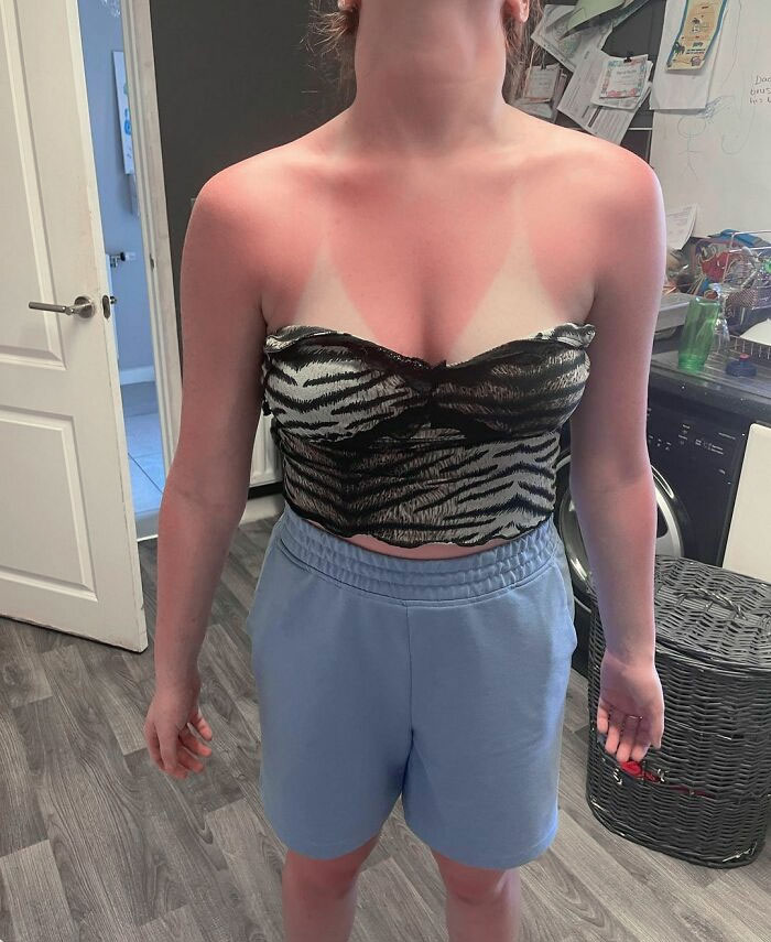 So Skye Was Wearing Factor 50 And Still Got Burnt