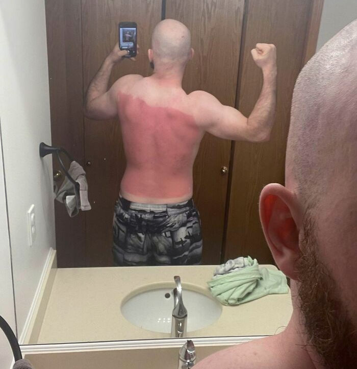 I Managed To Make Almost A Perfect Straight Edged Rectangle On My Back With My Haphazard Sunscreen Application. I Am Not Accepting Hugs At This Time