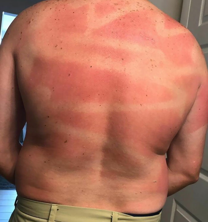 When You Fail At Your Wifey Duties Of Applying Sunscreen On Your Husband. I Blame The Spray Sunscreen. Or We Can Just Call It Art