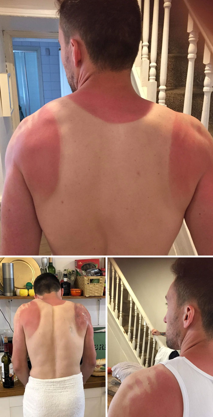 Ran The London Marathon A Couple Of Years Back. Think I Missed A Bit With The Sunscreen