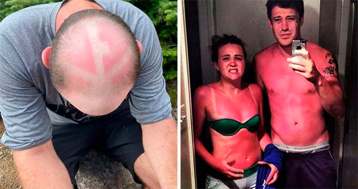 “I Don’t Need Sunscreen”: 50 People Who Thought So And Ended Up Looking Like Dorks (New Pics)