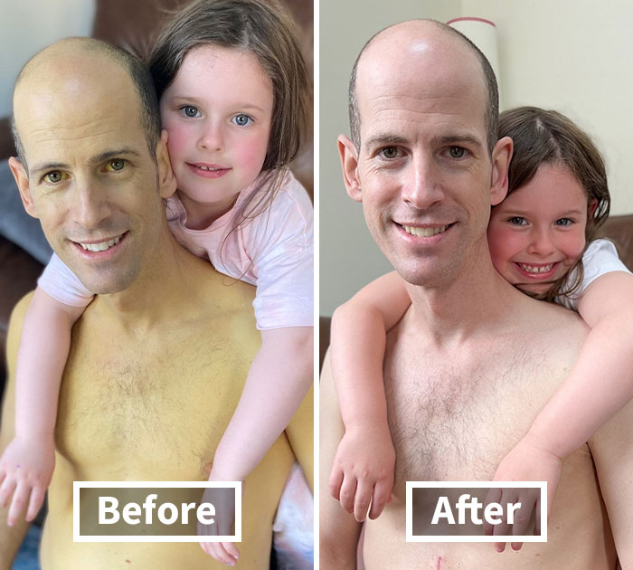 Dad Saved By Liver Transplant Shares Pictures Taken Before And After, Showing His Remarkable Recovery
