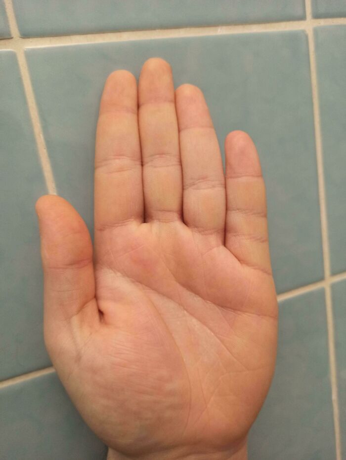 The Pinkie On My Left Hand Has An Extra Fold