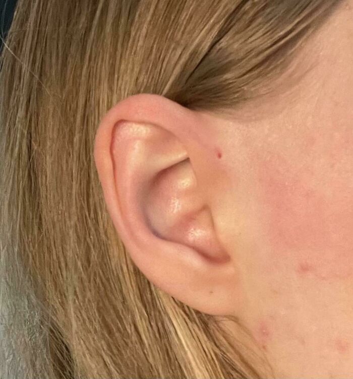 I Was Born With A Hole At The Top Of My Ear That Used To “Cry” When I Cried As A Baby