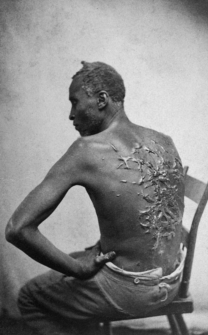 El esclavo fugitivo Peter, exponiendo su espalda severamente azotada