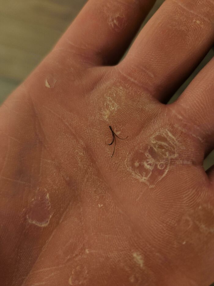 I Accidently Pulled Out A Cluster Of 5 Beard Hairs All From The Same Follicle