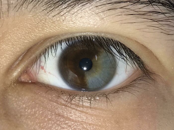 Only 2/3 Of My Left Eye Is Brown