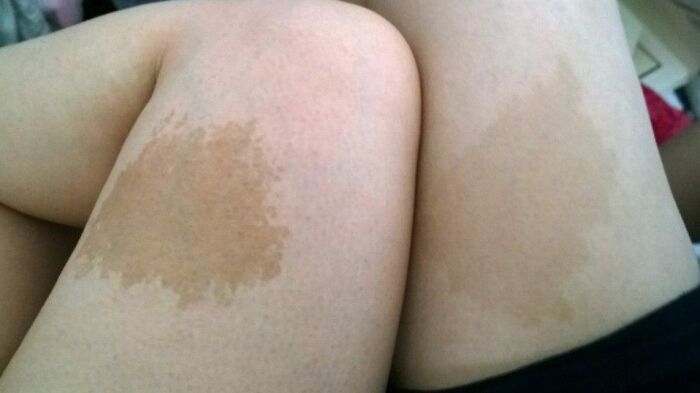 When I Met My Wife, We Didn't Know At The Time But It Turns Out That We Have Similar Looking Birthmarks On Our Thighs