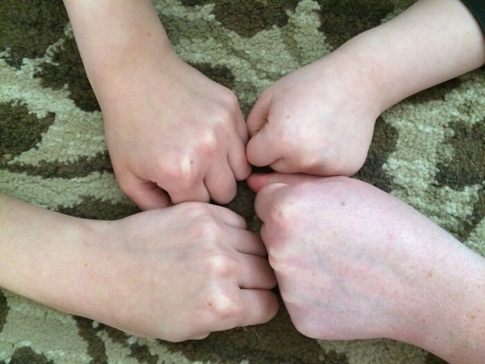 My Wife And Kids Have A Birthmark On The Same Spot On Their Index Knuckle