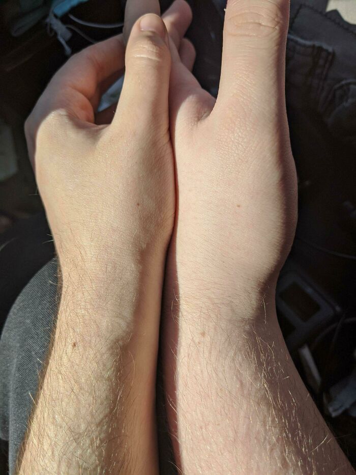 My Boyfriend And I Have Matching Moles