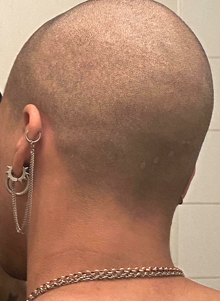 My Partner's Birthmark Behind His Head That Looks Like He's Been Unplugged