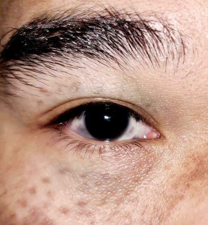 I Have Birthmark Inside My Eye