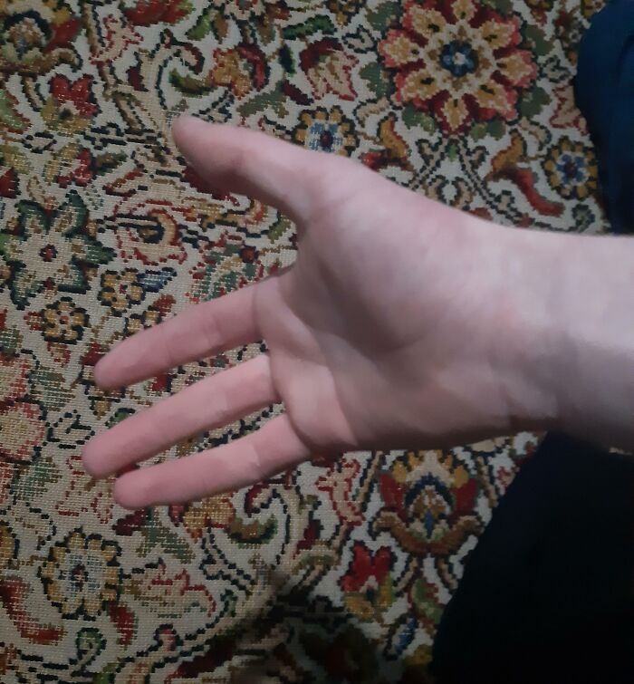 I Was Born Missing A Finger On My Right Hand, Left Hand Is Completely Normal
