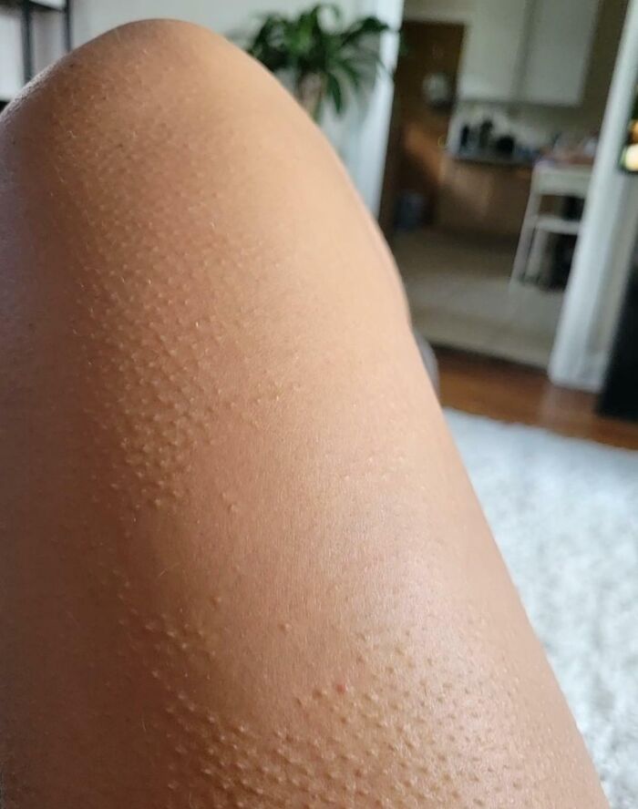 There's A Patch On My Leg That Doesn't Get Goosebumps