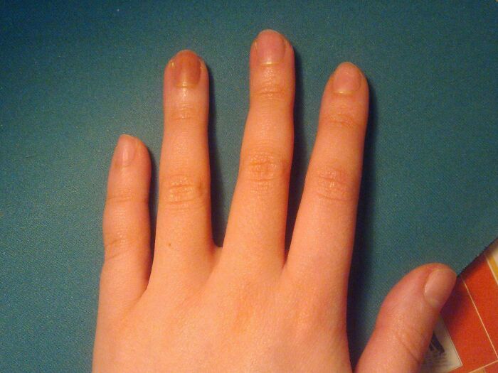 I've Had A Brown Fingernail My Whole Life. I've Never Come Across Anyone Else With One, And Doctors Have No Idea What Causes It