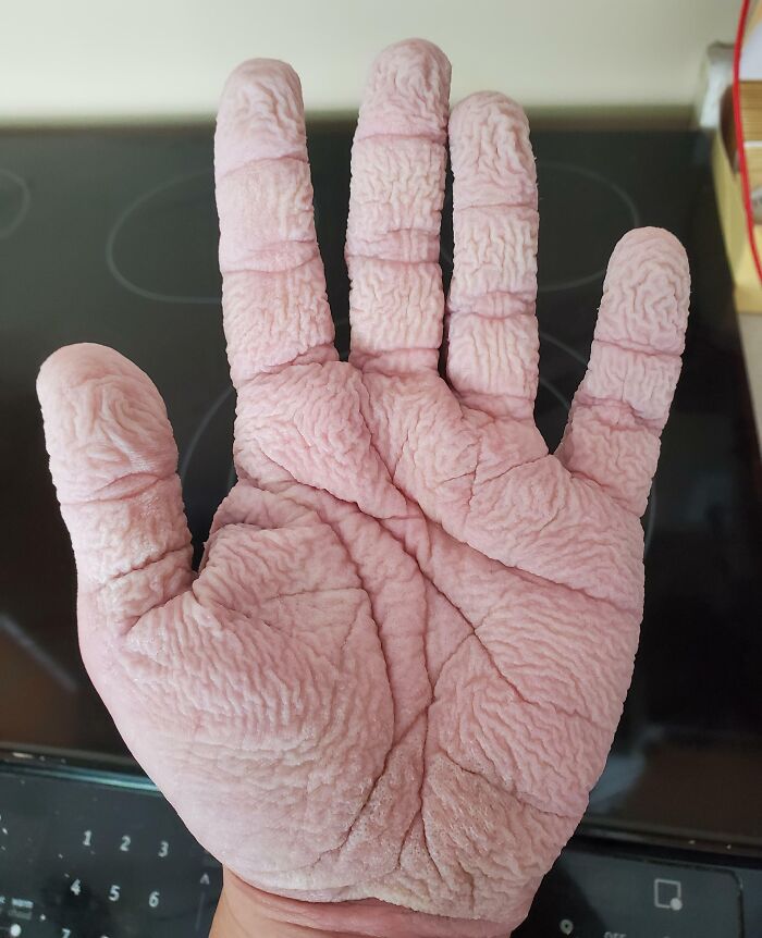 My Hands After Washing The Dishes For 20 Minutes