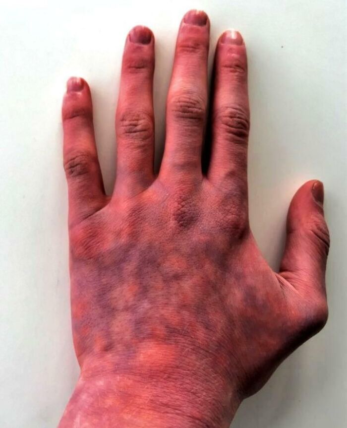 This Happens To My Hands At Cold Temperatures