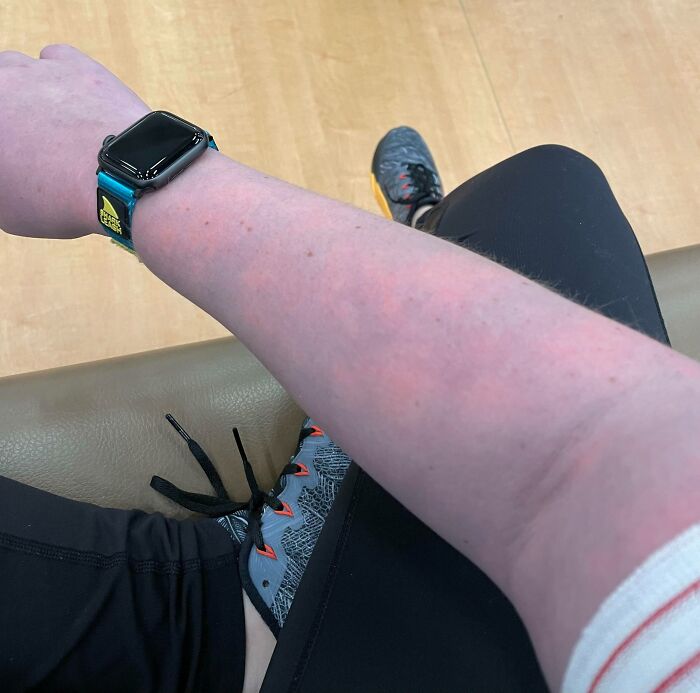 I Have A Vascular Issue Which Makes My Arms Turn Purple And Orange When Cold