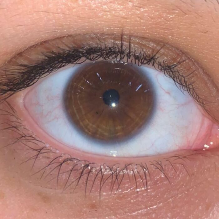 Found Out I Have Something Called “Nerve Rings” In My Eyes