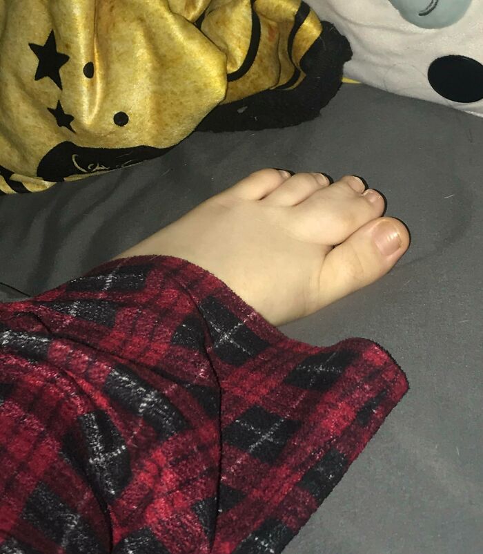 I Have A Conjoined Toe