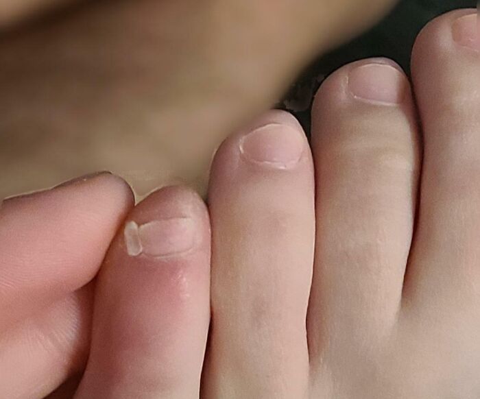 I Have A 6th Toenail On My Left Foot, Also Known As An Accessory Nail