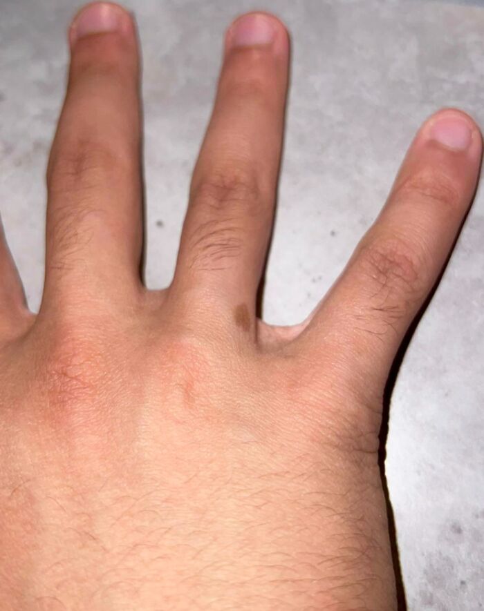 I Have A Birthmark That Is Heart-Shaped On My Ring Finger